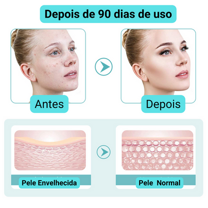 Aparelho de radiofrequência ShowLindt Hifu