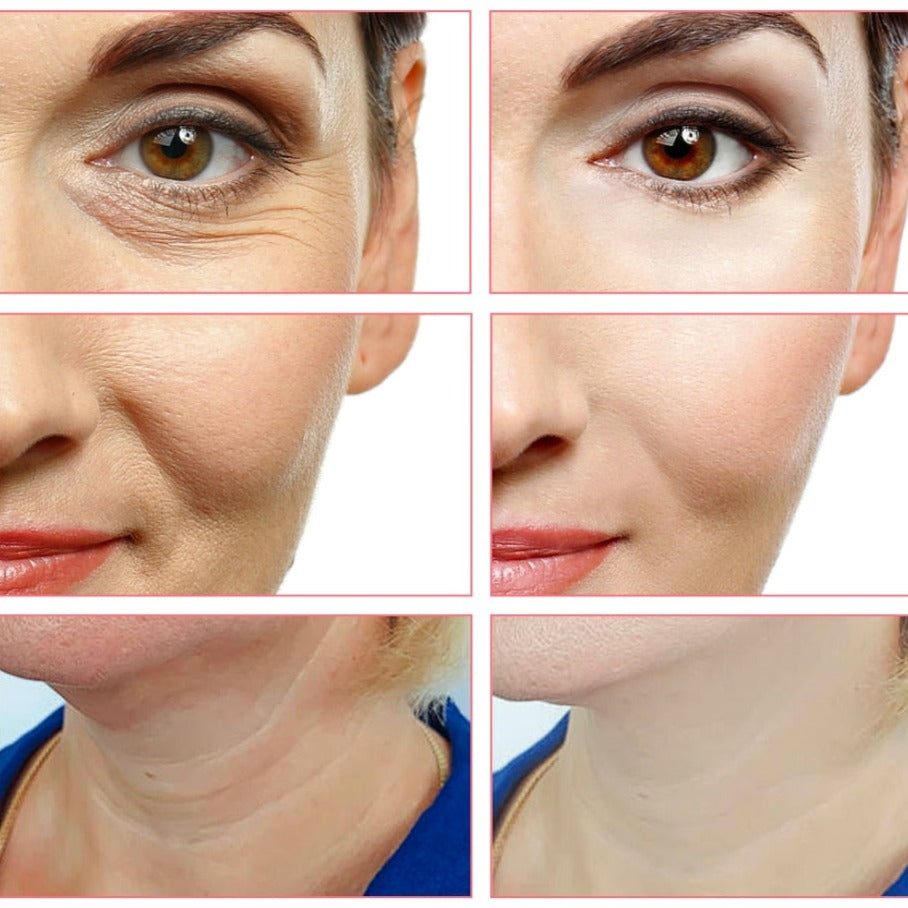 Aparelho de Radiofrequência Portátil FREMAS